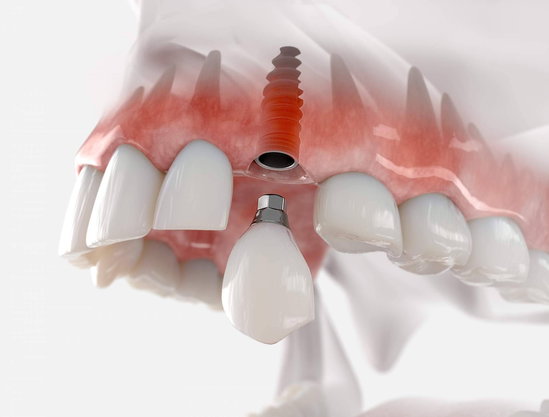 La Clínica Artydents en Madrid se consolida como la líder del sector gracias a la calidad de su implante dental de titanio V